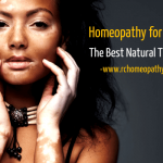 Best Natural Vitiligo Remedy with Homeopathy