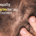 Homeopathy as an Effective Hair Loss Remedy