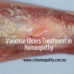 Varicose Ulcers Remedies in Homeopathy