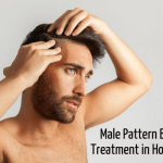 MALE PATTERN BALDNESS TREATMENT IN HOMEOPATHY?
